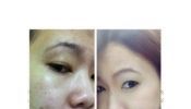 Serum for Scars/acne healing, dark spots, uneven skin, improve hair gr...